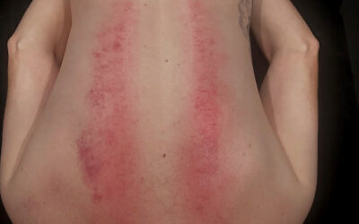 How Targeted Fascia Release Helps Athlete Recovery